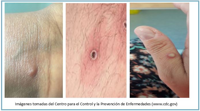 Sntomas de la viruela del mono. Imgenes tomadas del Centro para el Control y la Prevencin de Enfermedades