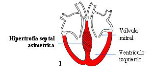 Hipertrofia Septal Asimtrica sin Obstruccin.