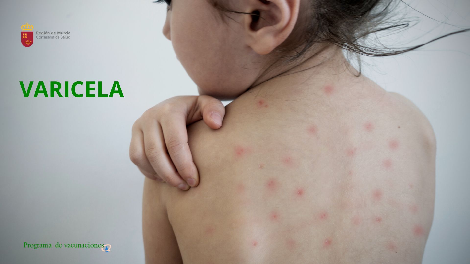 Campañas de vacunación frente a la varicela