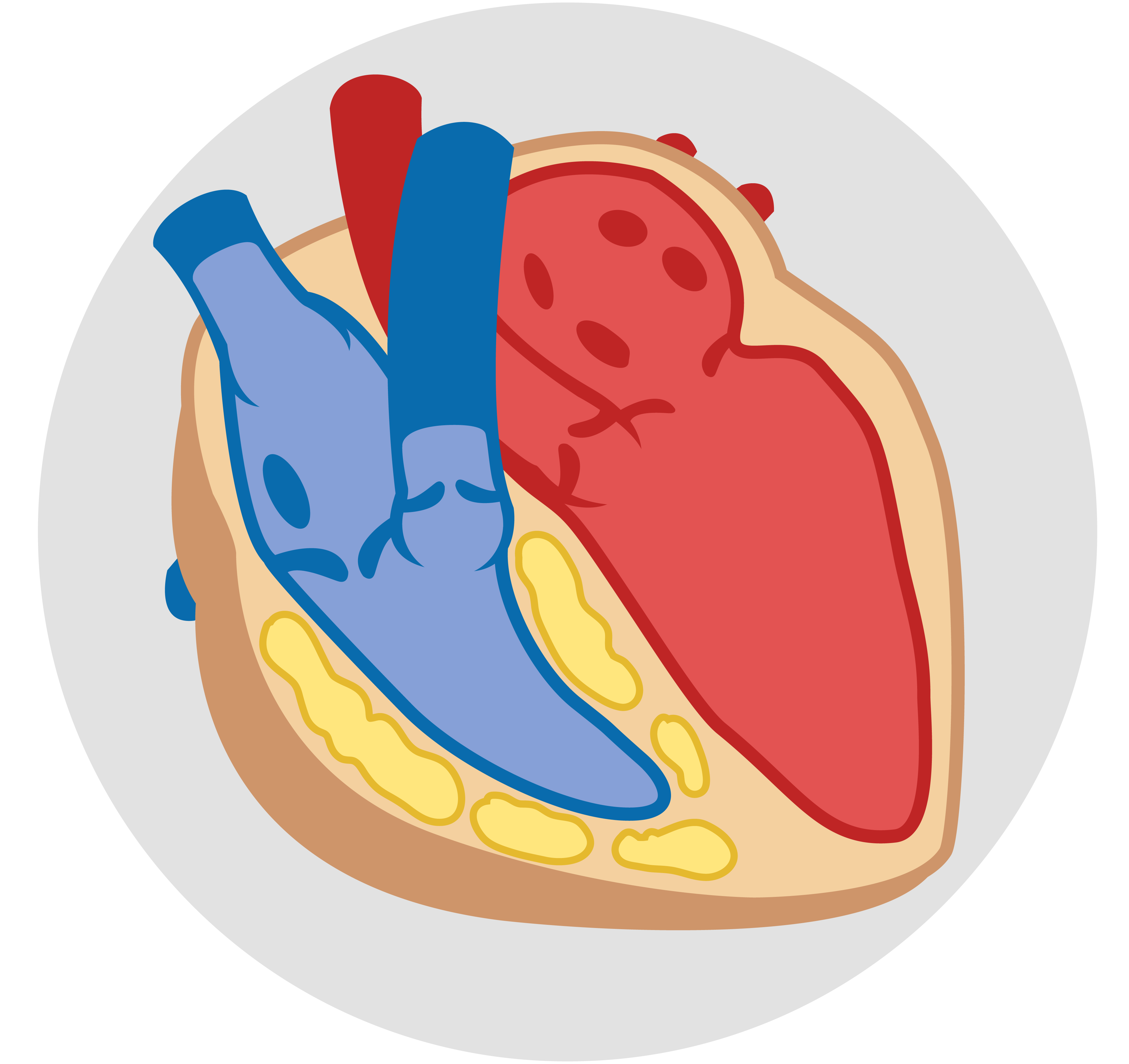 Miocardiopatía arritmogénica de ventrículo derecho