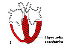 Hipertrofia Simétrica
